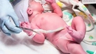 Researchers Say Umbilical Cords Being Cut too Early